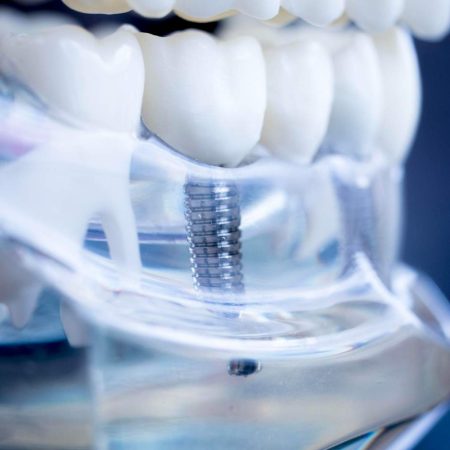 Implantes dentales en Zorroza