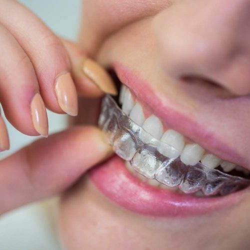 Artículo Invisalign